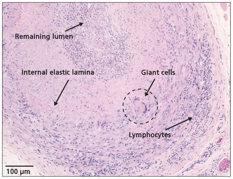 Temporal artery biopsy in Giant Cell Arteritis