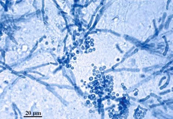 Malassezia furfur "spaghetti and meatballs"