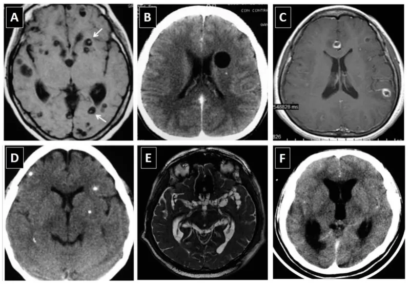 Neurocysticercosis CT/MRI showing scolex and lesions