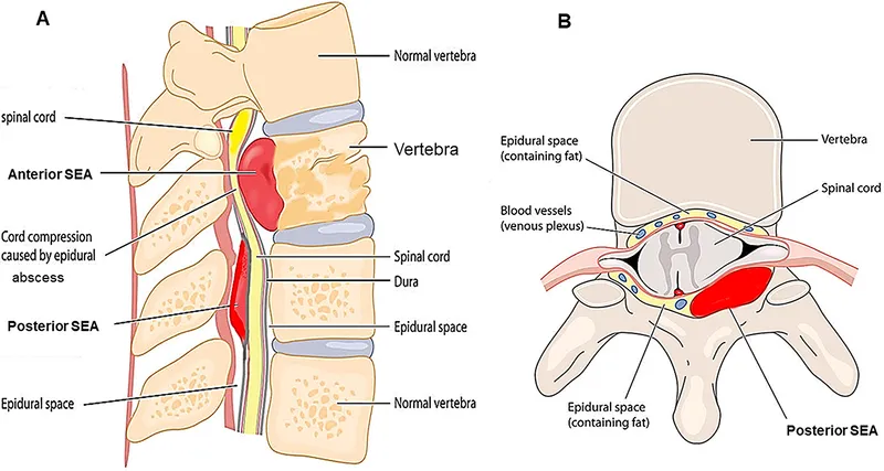Spinal Epidural Abscess with Cord Compression