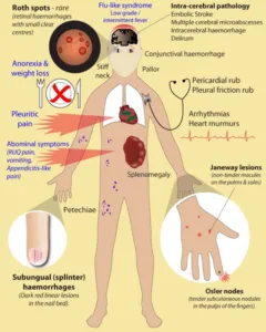 Clinical Manifestations of Infective Endocarditis