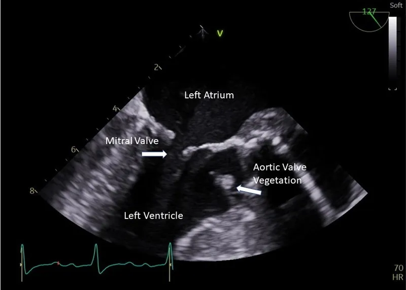Echocardiogram: Aortic Valve Vegetation in Endocarditis