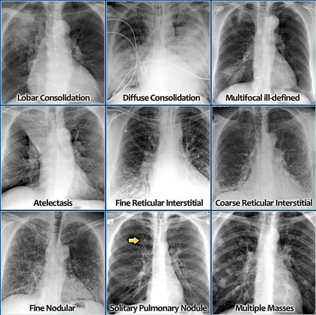 Chest X-ray patterns in pneumonia