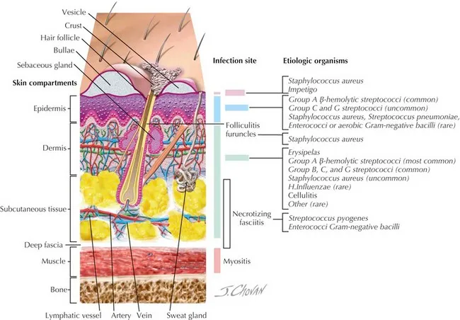 Skin infection depth and etiology