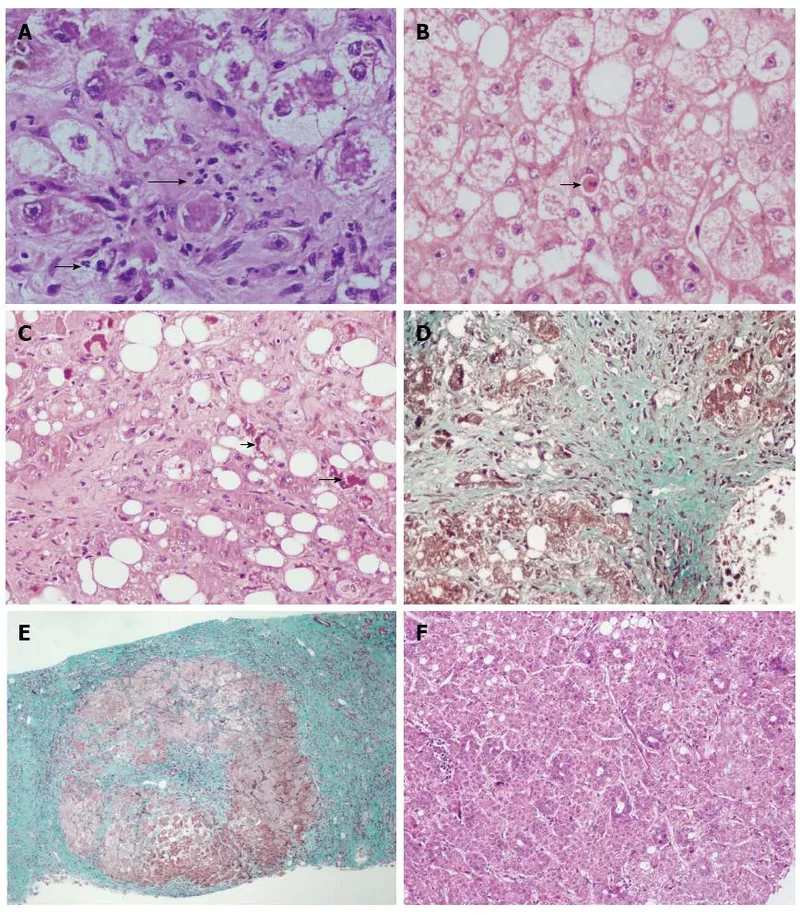 Histopathology of alcoholic liver disease