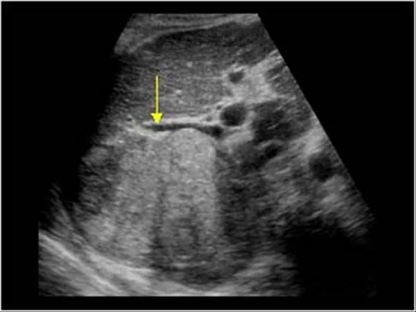 Ultrasound: Liver with HCC and portal vein thrombosis