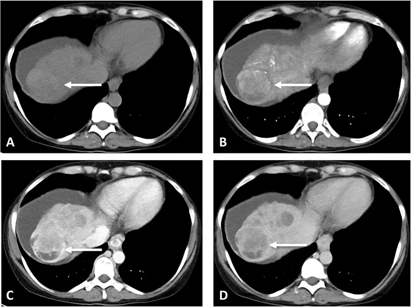 HCC on multiphasic CT: arterial hyperenhancement, washout