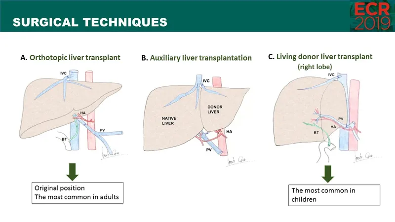 Liver Transplant Surgical Techniques