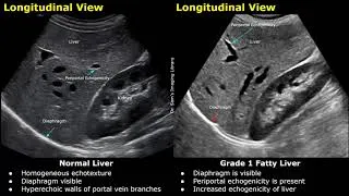 Ultrasound: Normal vs. Grade 1 Fatty Liver