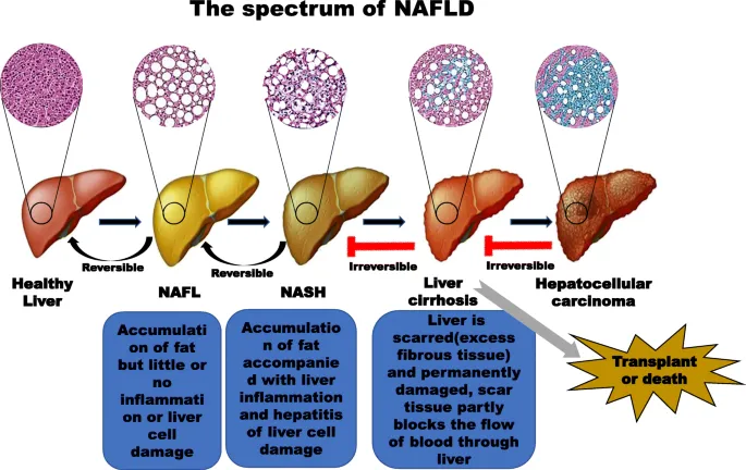 NAFLD progression: healthy liver to carcinoma