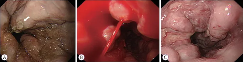 Endoscopic views of esophageal varices and active bleeding