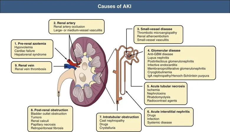 Causes of AKI