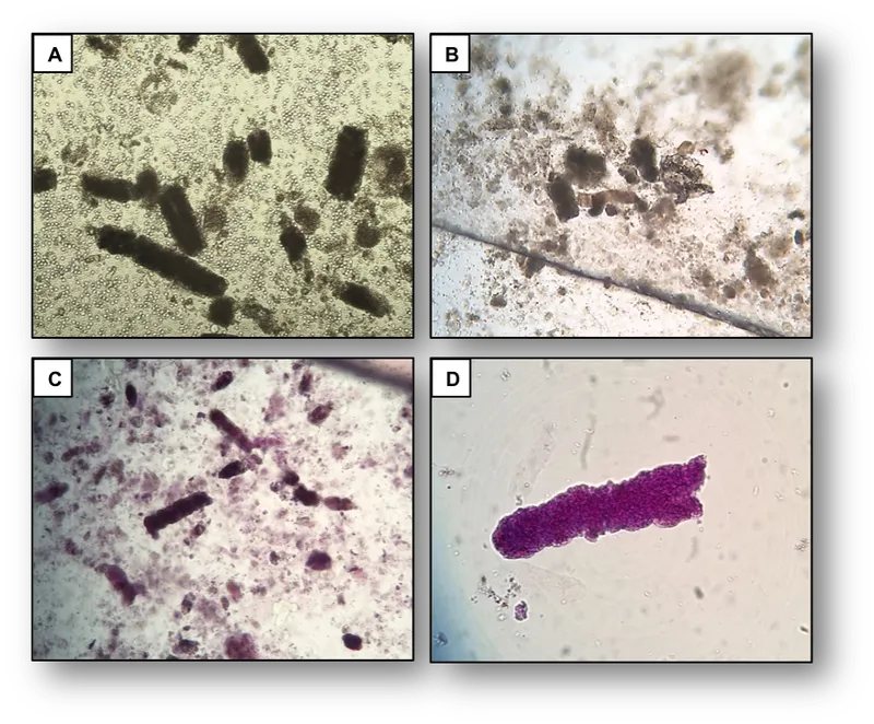 Muddy brown granular casts in urine sediment