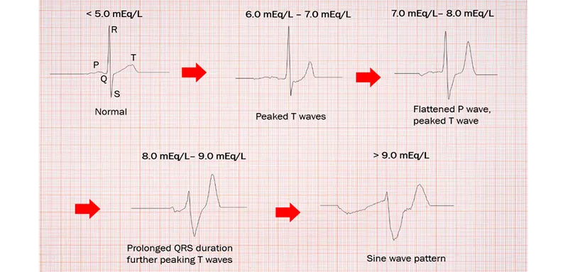 Hyperkalemia EKG progression
