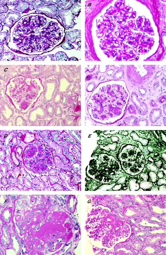 Histopathology of Diabetic Nephropathy
