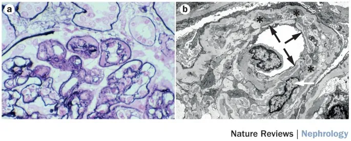 MPGN tram-track appearance (light and electron microscopy)