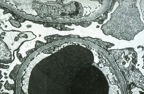 EM of podocyte foot process effacement in MCD