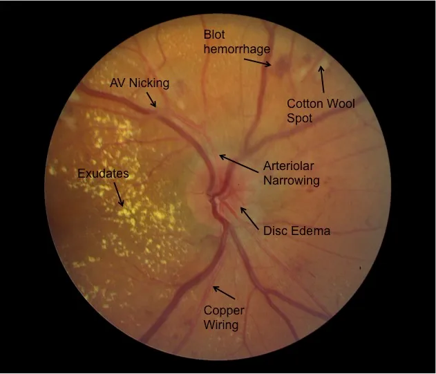 Fundoscopy: Hypertensive Retinopathy with AV Nicking