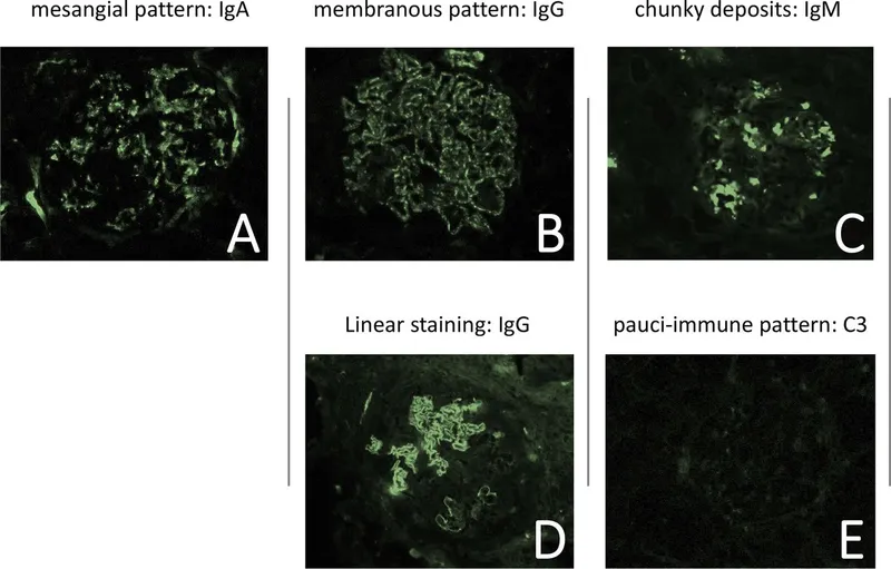 Immunofluorescence patterns in nephritic syndrome