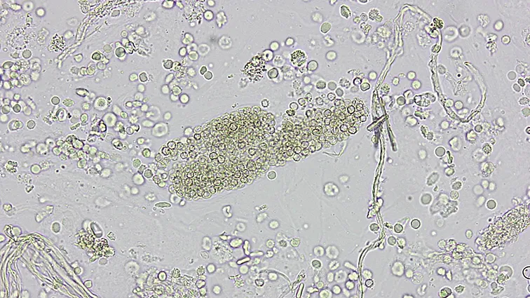 Red blood cell casts in urine sediment