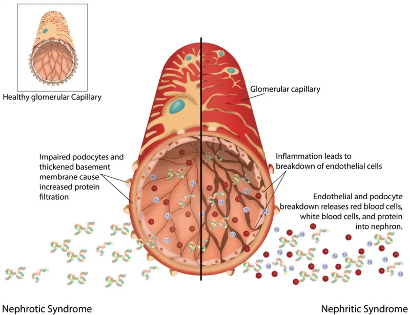 Nephrotic vs. Nephritic Syndrome Glomerular Damage