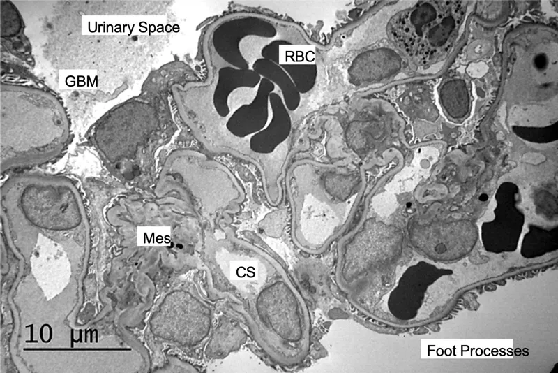 Electron micrograph of glomerulus with mesangial expansion