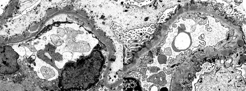 EM of podocyte effacement and spike and dome appearance