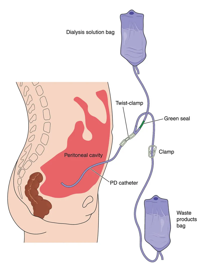 Peritoneal Dialysis Setup