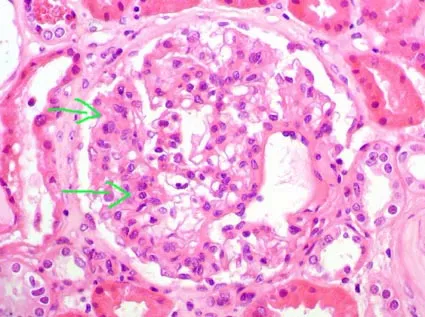 Lupus Nephritis: Diffuse Proliferative Changes & Wire Loops