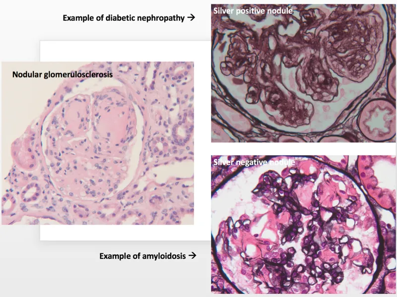 Diabetic nephropathy vs. amyloidosis histology