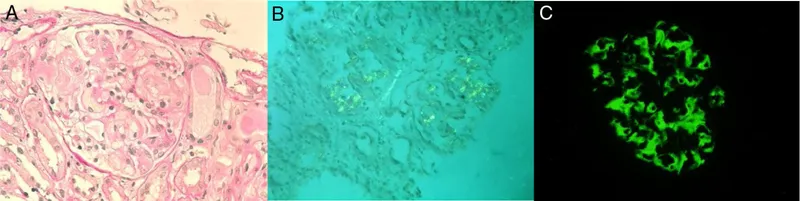 Renal amyloidosis: H&E, Congo red, and immunofluorescence