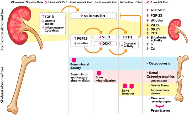 CKD-MBD Pathophysiology by GFR