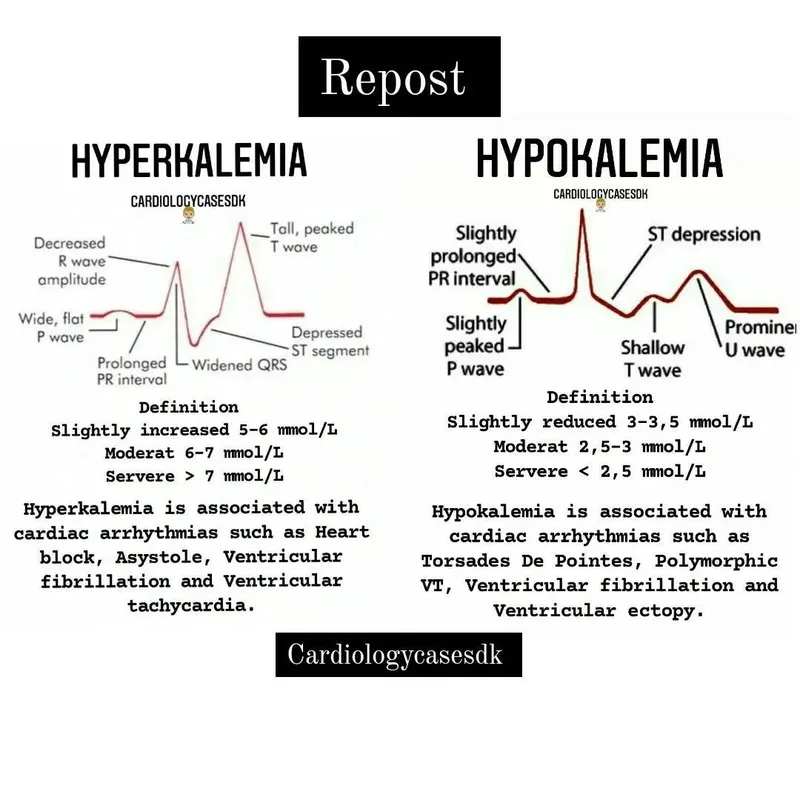 ECG changes in hyperkalemia vs hypokalemia