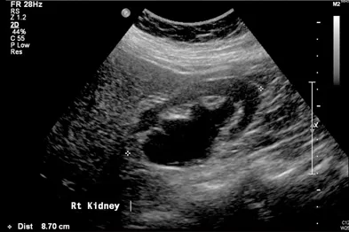 Ultrasound of right kidney with hydronephrosis