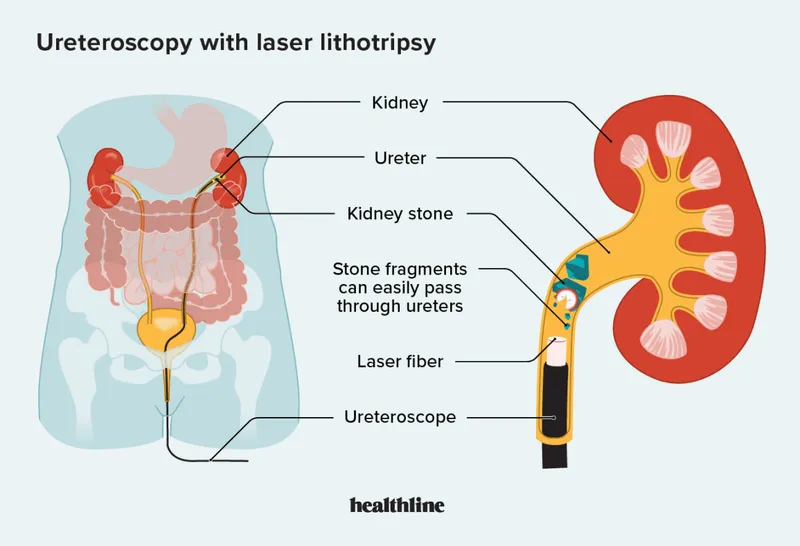 Ureteroscopy with laser lithotripsy