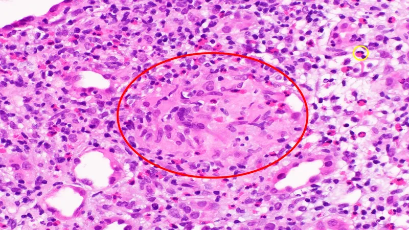 Kidney biopsy showing granulomatous interstitial nephritis
