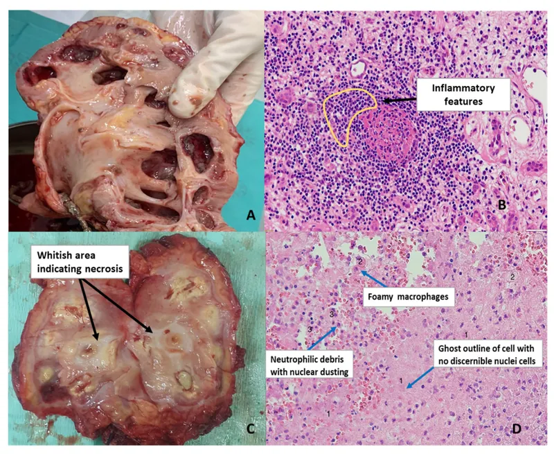Analgesic Nephropathy: Gross and Microscopic Pathology