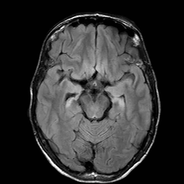 MRI showing bilateral temporal lobe hyperintensity in HSV