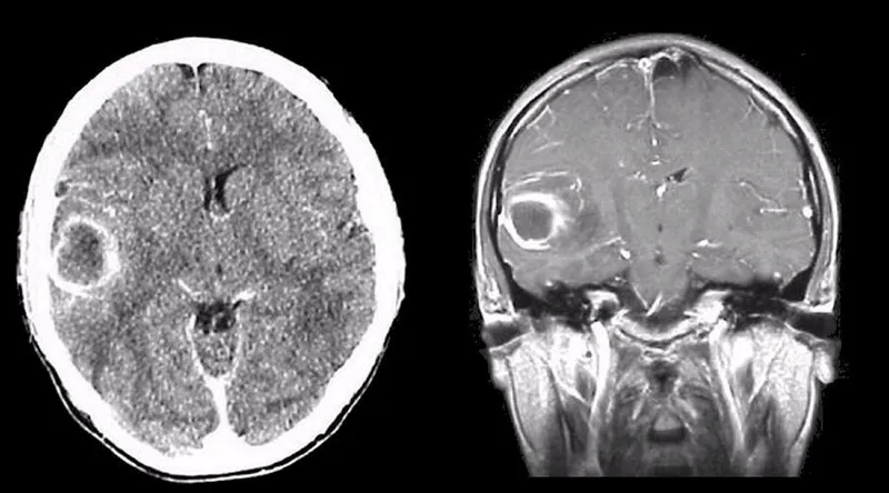CT and MRI showing ring-enhancing brain abscess