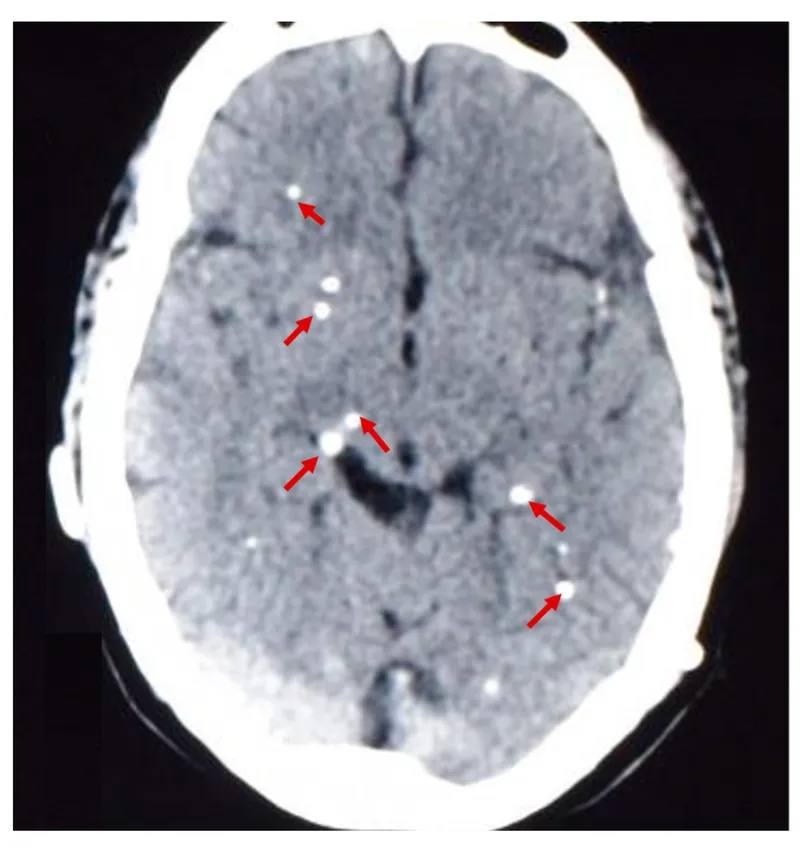 Neurocysticercosis brain CT with multiple calcifications