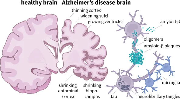 Alzheimer's Brain Changes: Macro and Micro