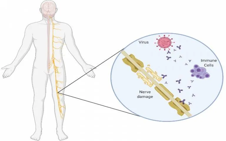 GBS Peripheral Nerve Demyelination