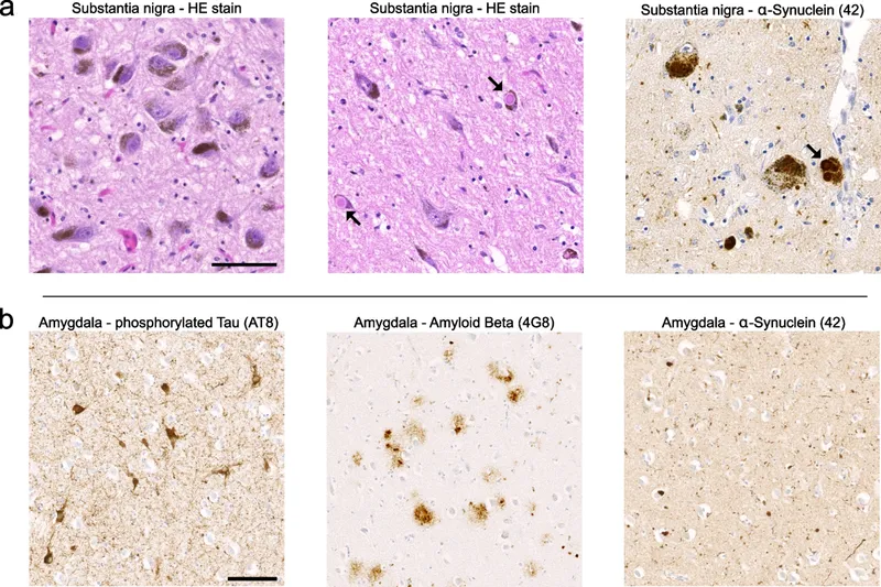 Substantia Nigra and Amygdala Histopathology in PD