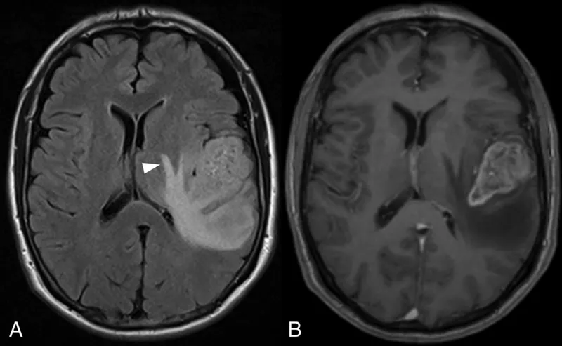 MRI Brain Tumor with Mass Effect and Peritumoral Edema