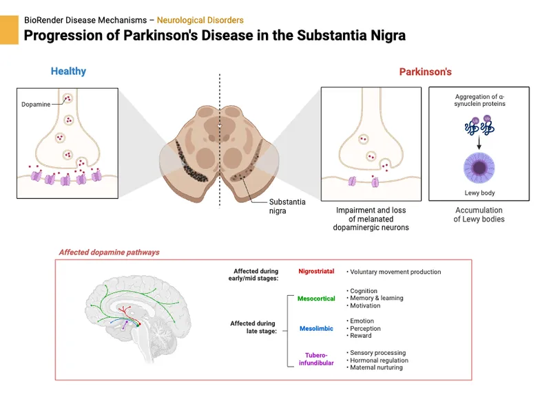 Parkinson's Disease Progression in Substantia Nigra