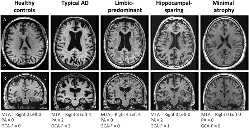 Brain MRI: Alzheimer's disease atrophy patterns