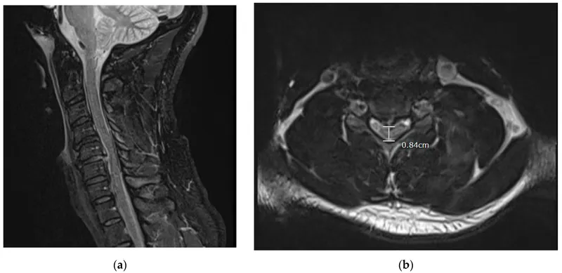 MRI showing spinal cord compression