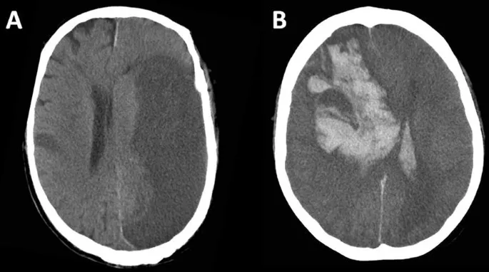 CT brain: Ischemic vs hemorrhagic stroke