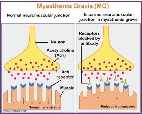 Myasthenia Gravis Neuromuscular Junction Impairment