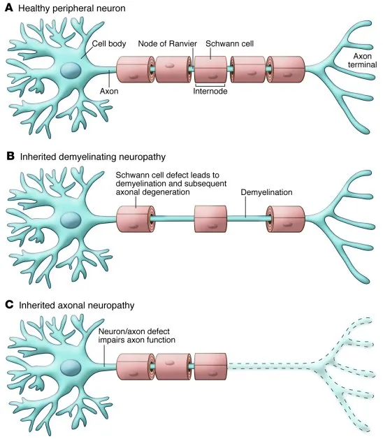 Healthy vs. demyelinating vs. axonal neuropathy